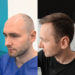 Przeszczep włosów – jak wybrać sprawdzoną klinikę i uzyskać naturalny efekt?